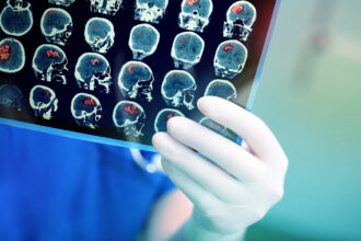 καρκίνος εγκεφάλου - μαγνητική τομογραφία MedTech: Η τεχνολογία που «χαρτογραφεί» τους όγκους του εγκεφάλου για στοχευμένη θεραπεία